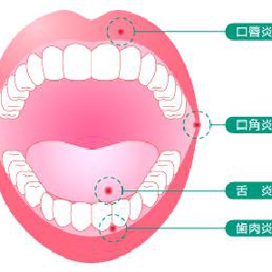 口内炎の原因と対策